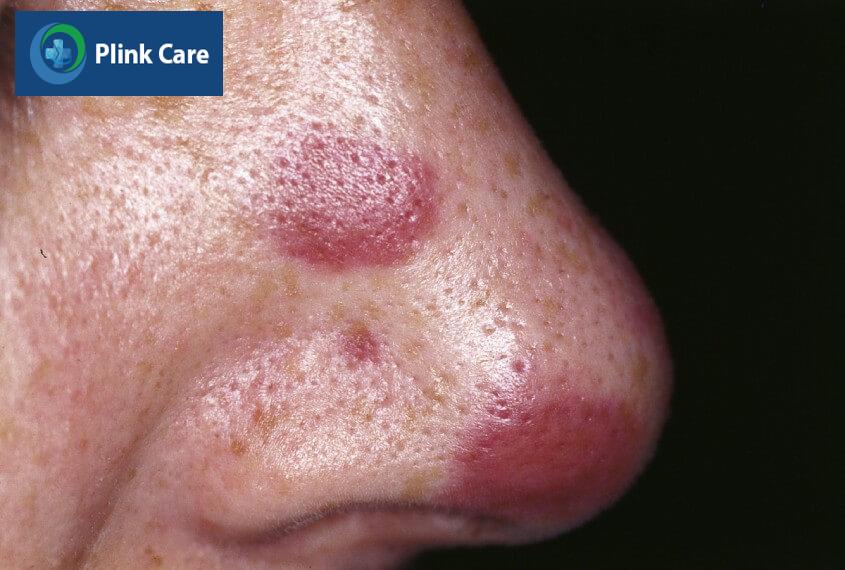 hình ảnh kaposi sarcoma