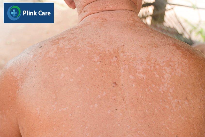 hình ảnh lang ben trắng phía sau gáy lan xuống lưng
