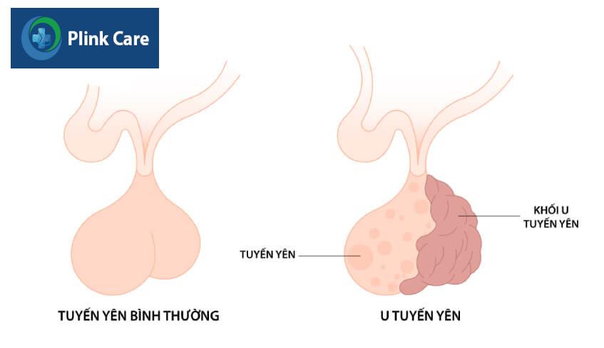 khối u tuyến yên cần phẫu thuật