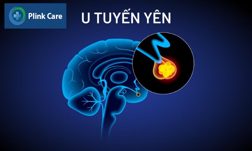 khối u tuyến yên