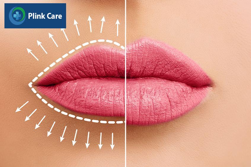 làm sao để giảm tác dụng phụ khi tiêm filler môi