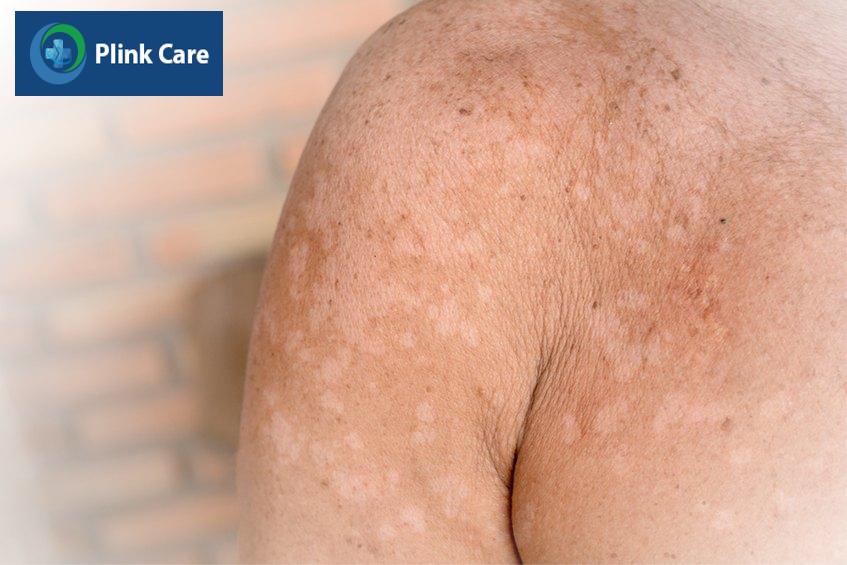 hình ảnh lang ben trắng phía trước vai