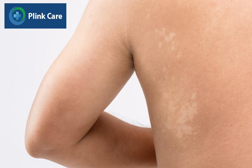 lang ben nếu không điều trị sớm sẽ như thế nào