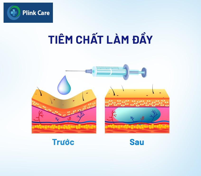 lưu ý sau tiêm filler má