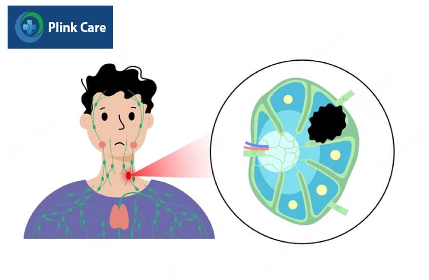 lymphoma