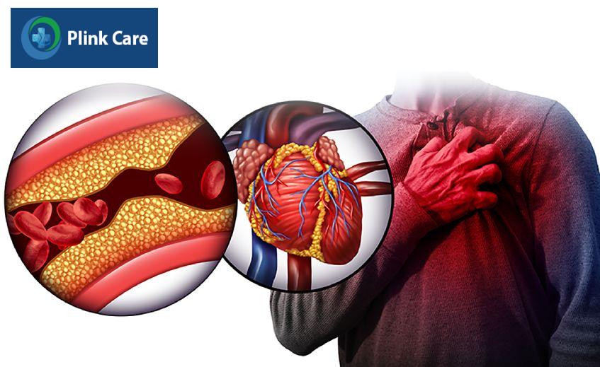 Máu nhiễm mỡ là yếu tố nguy cơ dẫn đến nhồi máu cơ tim, đột quỵ não