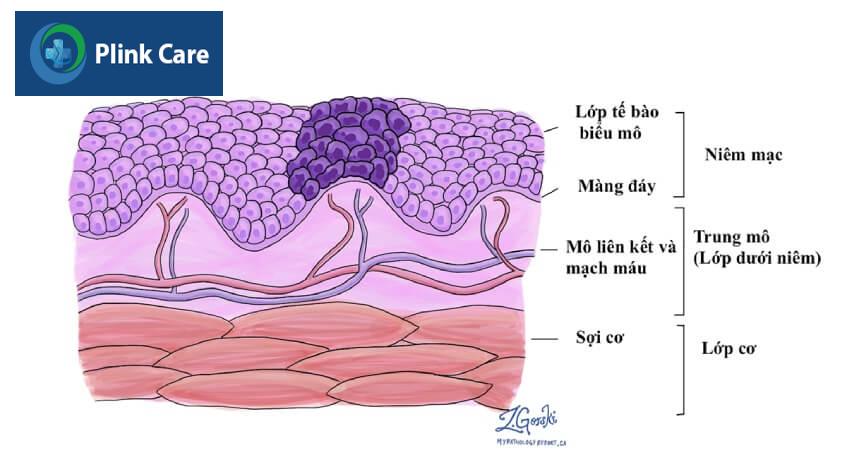 minh họa tế bào ác tính thanh quản