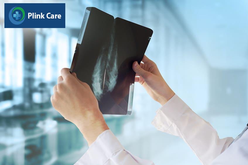 mức độ ung thư biểu mô tiểu thùy xâm lấn