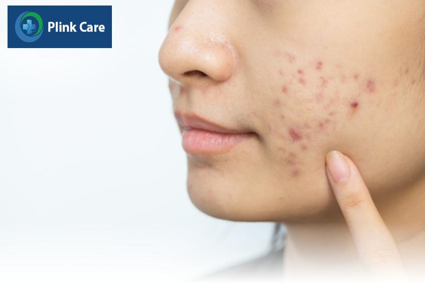 Mụn ở má xuất hiện do bã nhờn thừa
