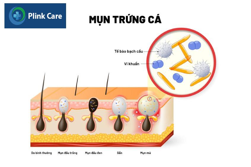 Mụn trứng cá tích tụ nhiều vi khuẩn
