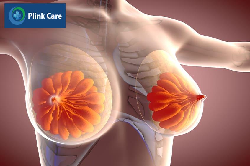 Người mang đột biến gen BRCA1 hoặc BRCA2 thì bị ung thư vú
