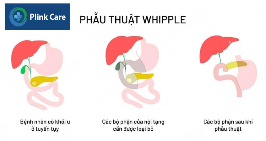 phẫu thuật điều trị ung thư tụy