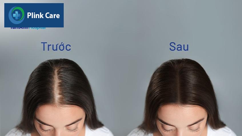 phương pháp cải thiện tình trạng hói đầu