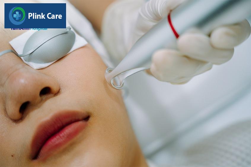 phương pháp laser để điều trị nám