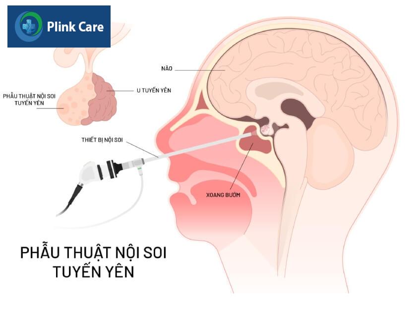 phương pháp phẫu thuật u tuyến yên