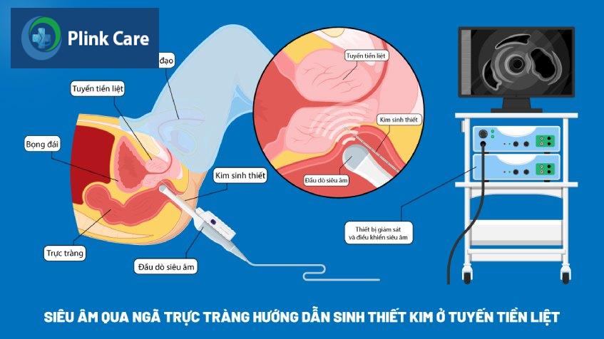 siêu âm qua ngã trực tràng