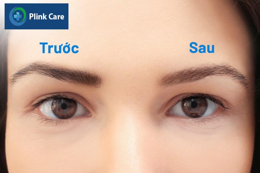 So sánh trước và sau khi xóa xăm chân mày.