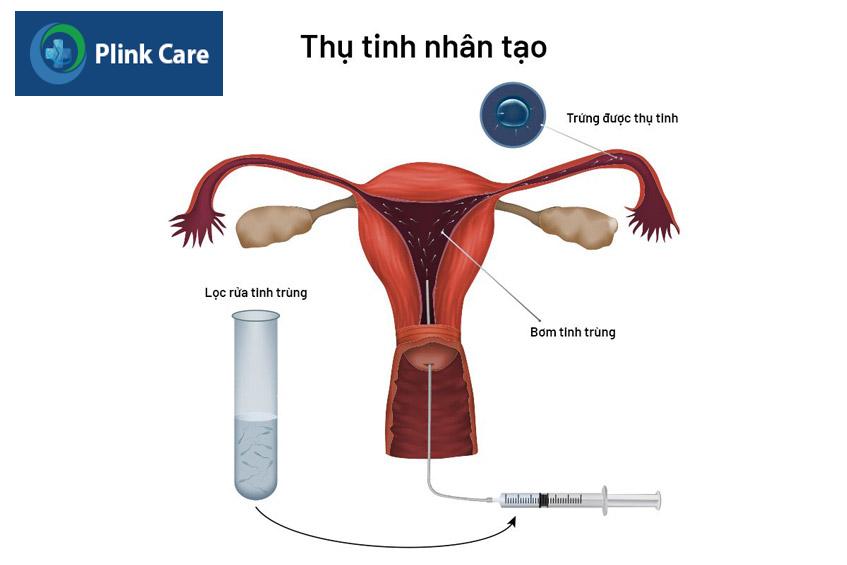 thụ tinh nhân tạo iui