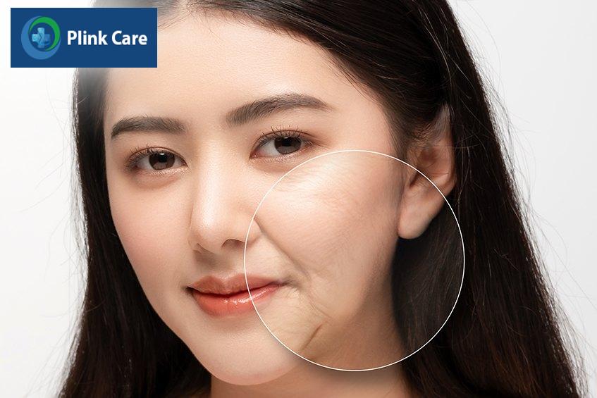 tiêm filler rãnh cười ở đâu tốt