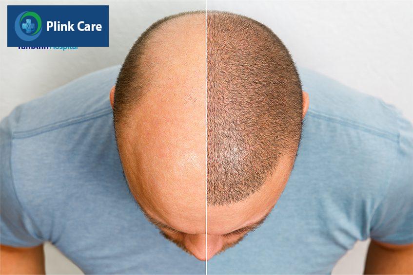 tình trạng hói đầu xuất hiện nhiều ở độ tuổi nào
