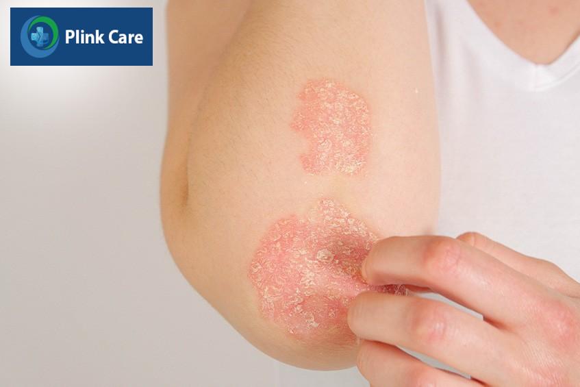 triệu chứng của bệnh vảy nến