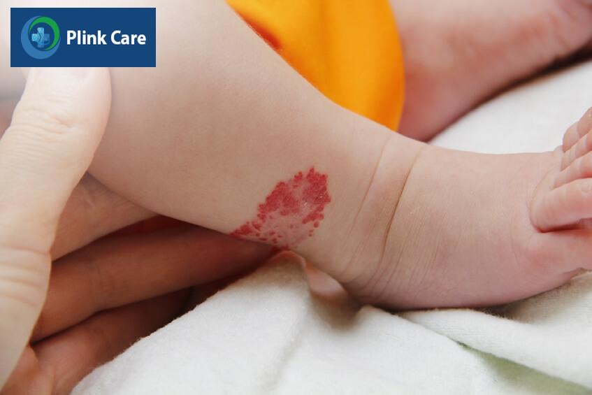 u máu nguy hiểm không phụ thuộc nhiều yếu tố