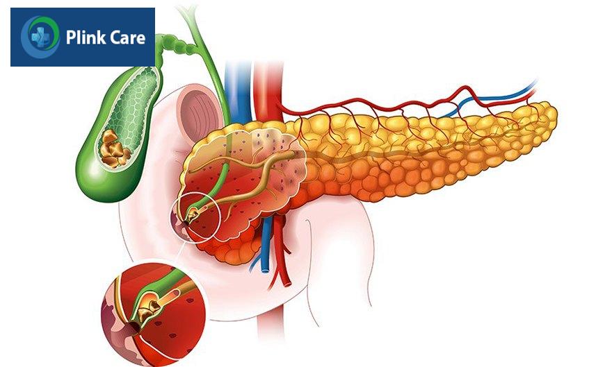 vị trí đau sỏi mật