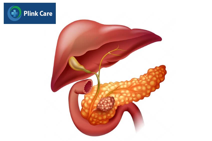 vị trí khối u đầu tụy