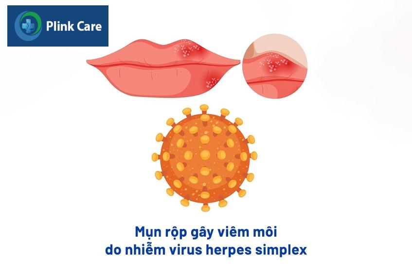viêm môi nhiễm trùng