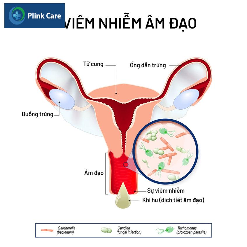 viêm nhiễm âm đạo