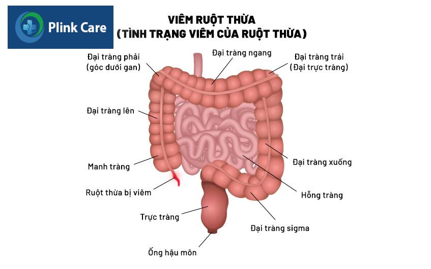 viêm ruột thừa mãn tính là gì