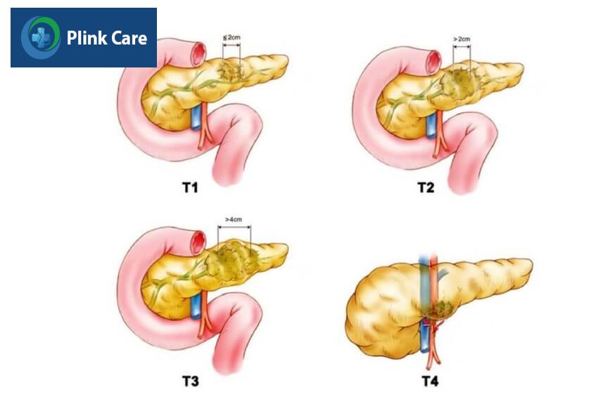 yếu tố t ung thư tuyến tụy