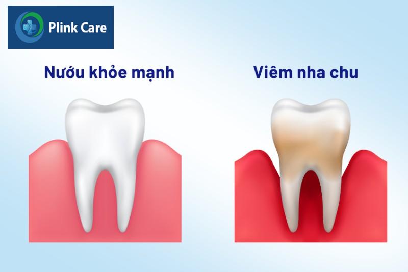 Dấu hiệu viêm nha chu