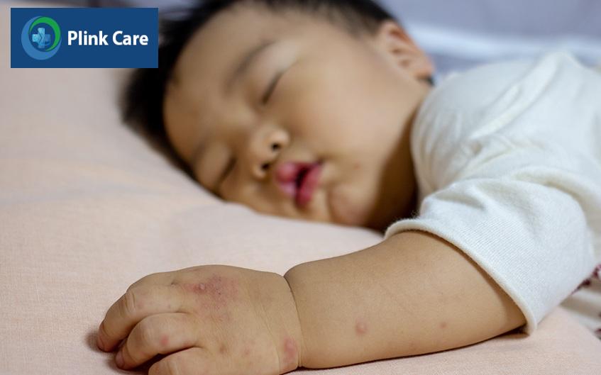 Bệnh tay chân miệng có nguy cơ gây biến chứng nguy hiểm