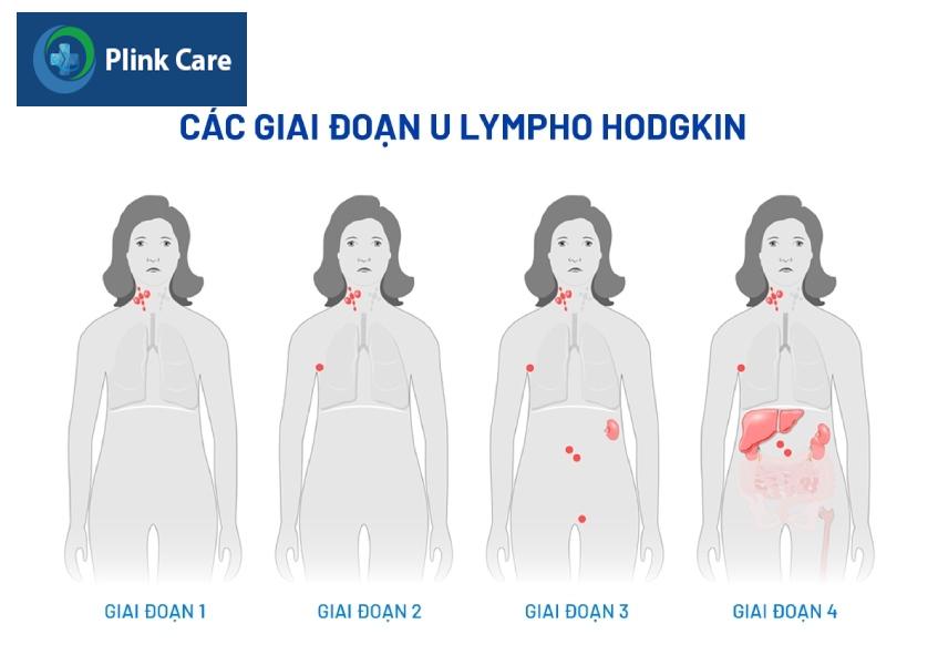 bênh u lympho hodgkin các giai đoạn