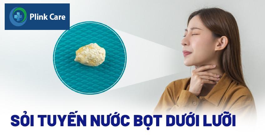 bị sỏi tuyến nước bọt dưới lưỡi