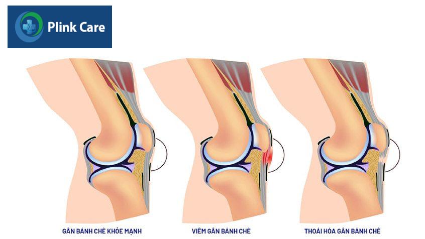 bị viêm và thoái hóa gân bánh chè