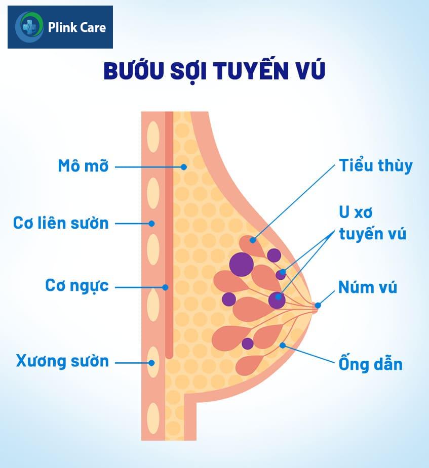 Biến chứng từ bệnh bướu sợi tuyến vú