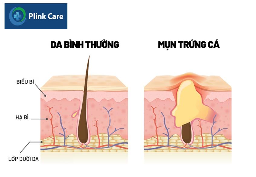 các dạng mụn trứng cá nặng