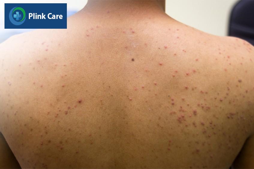 các loại viêm nang lông