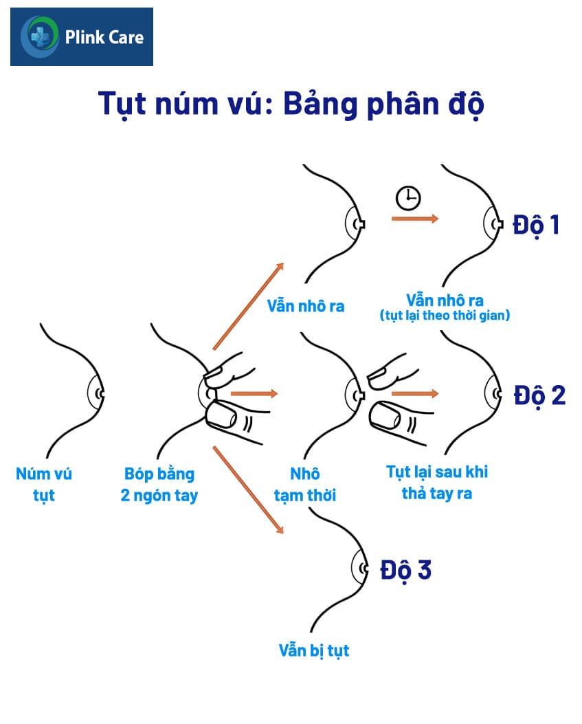 Các mức độ núm vú bị thụt