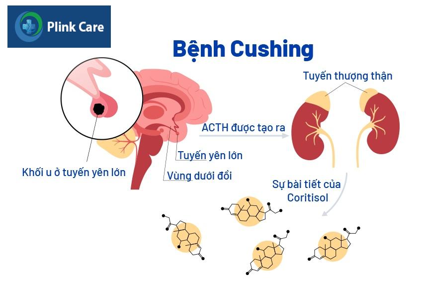 Các nguyên nhân chủ yếu gây hội chứng Cushing