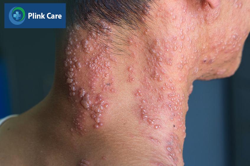 các thể bệnh zona thường gặp