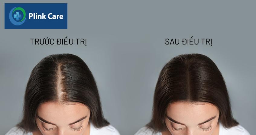cách chữa rụng tóc ở phụ nữ