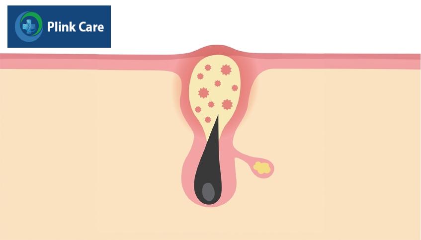 cách chẩn đoán mụn trứng cá đỏ