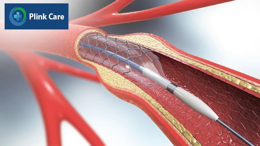 cách điều trị đột quỵ thiếu máu cục bộ
