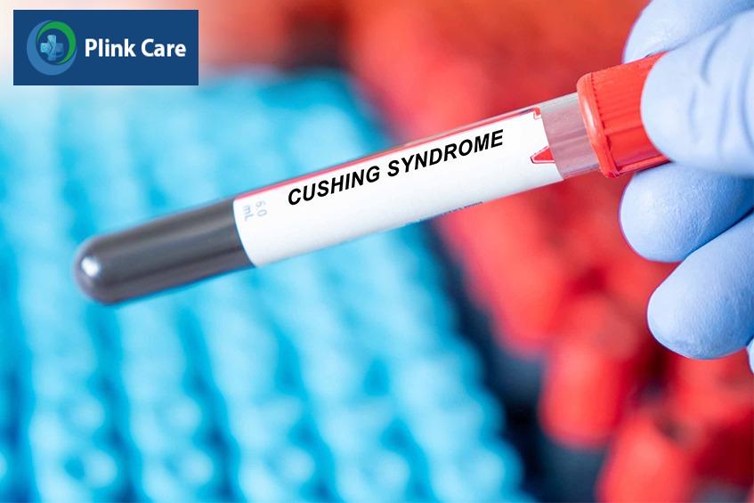 chẩn đoán chính xác hội chứng Cushing