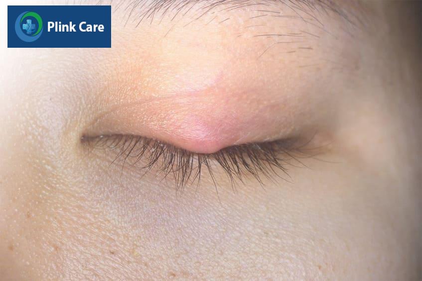 Chắp mắt bị vỡ mủ có nguy hiểm không