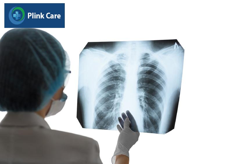 giá chụp x quang tràn dịch màng phổi