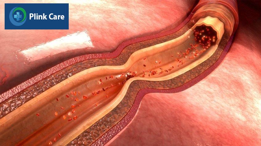 Có nhiều yếu tố dẫn đến bệnh co thắt động mạch vành